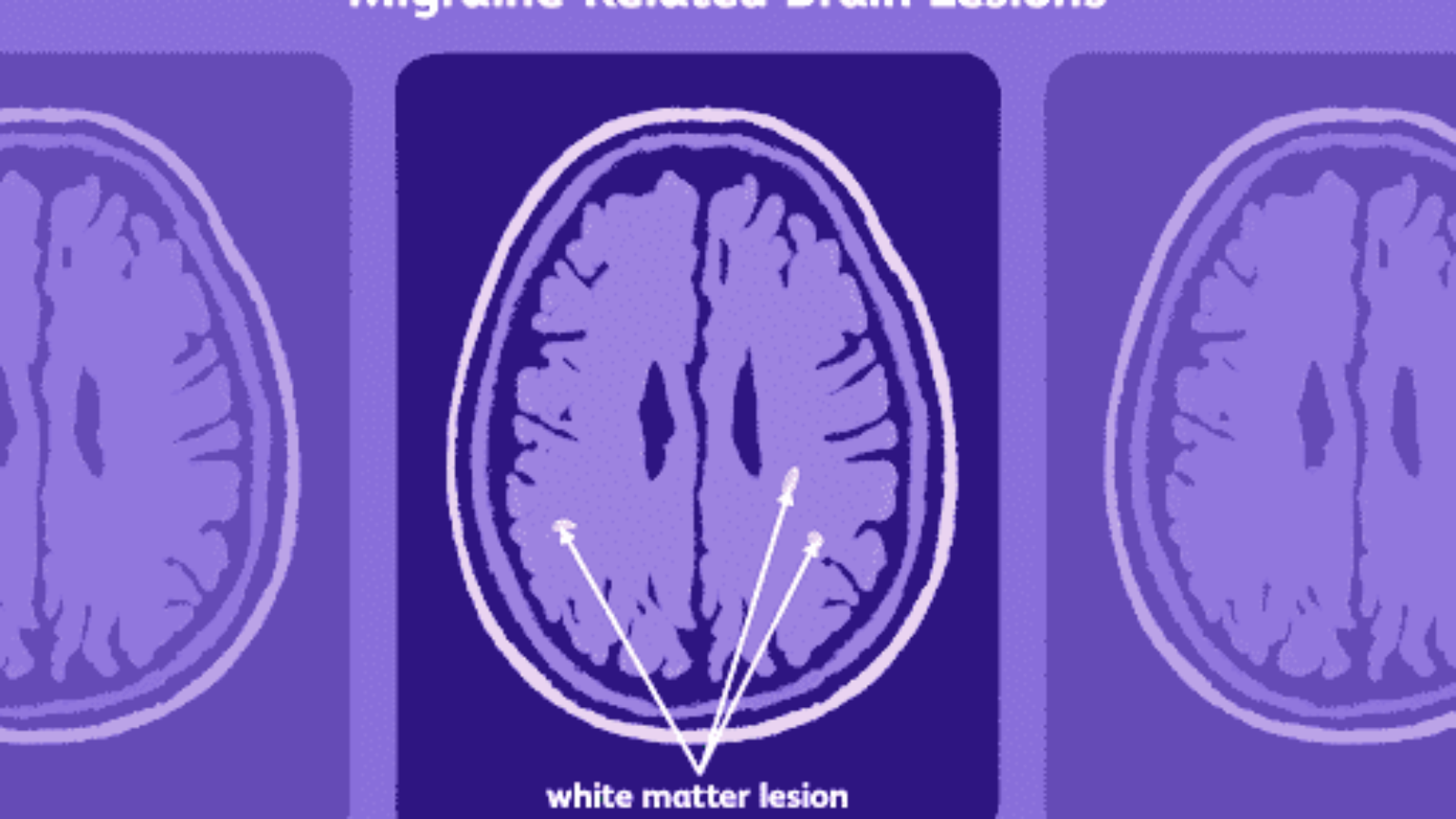 migraine2 (1)