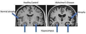 Current Trends in Alzheimer’s Research