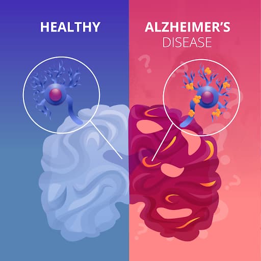 TDP-43: An Essential Protein in Alzheimer’s Disease